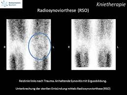 rso behandlung knie