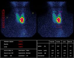 schilddrüse kontrastmittel szintigraphie