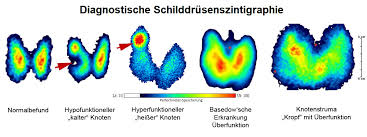 uniklinik schilddrüsenambulanz