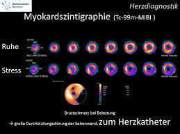 nukleare herzuntersuchung