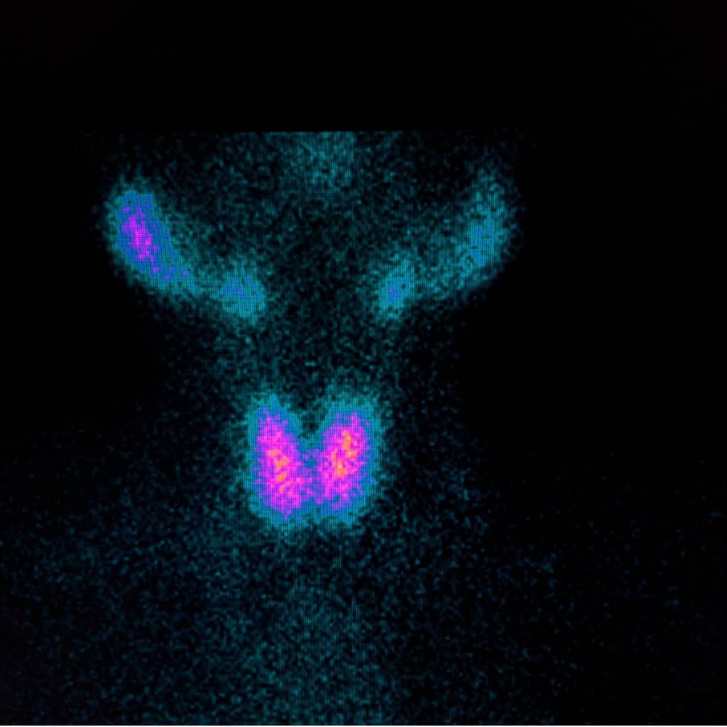 akh nuklearmedizin schilddrüsenambulanz