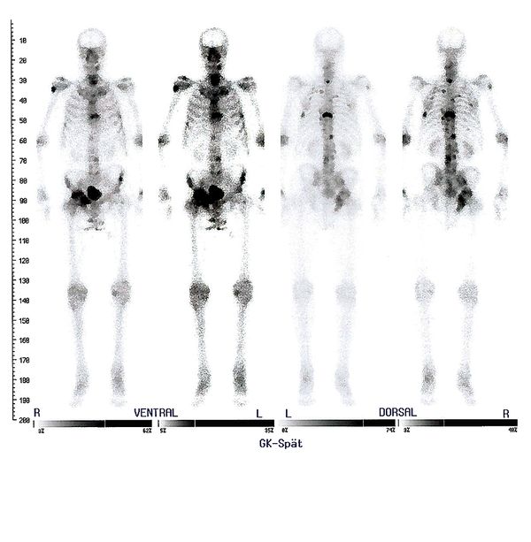 ganzkörper szintigraphie schilddrüse